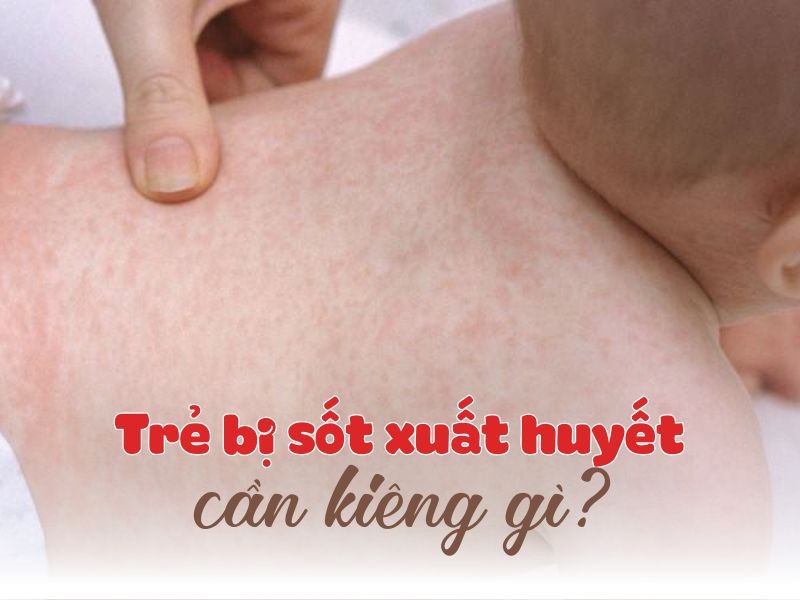 Trẻ bị sốt xuất huyết cần kiêng gì để không gặp biến chứng?